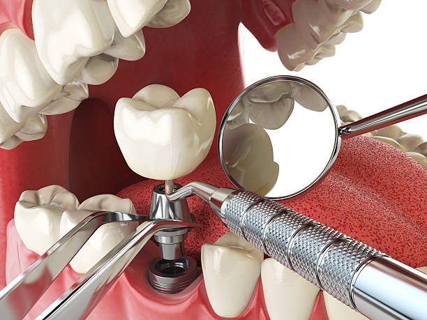 Best Emergency Dentist for Knocked-Out Tooth in Carthage, MO